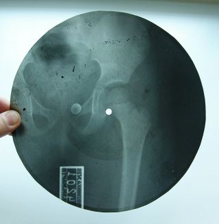 X - Ray 78rpm Sokolsky - Russian Tango Ussr Roentgen Bones Pelvis Hip Joint 1950s
